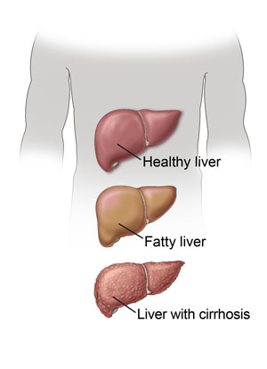 Healthy liver, fatty liver, liver with cirrhosis.