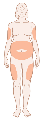 Front view of pregnant woman with insulin injection sites.