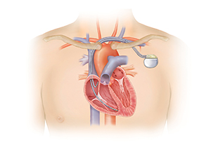Outline of chest showing cross section of heart with pacemaker in place. Generator is under collarbone with 2 leads entering vein and going into heart. Right atrial lead ends in right atrium and right ventricular lead ends in bottom of right ventricle.