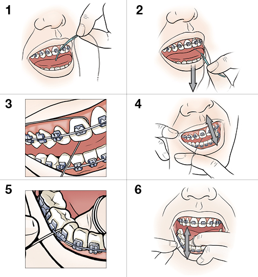 4 steps in flossing teeth and braces