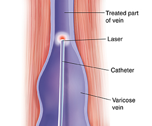 Cross section of muscle and vein showing laser catheter in vein.
