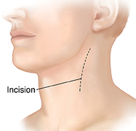 Three-quarter view of head and neck showing incision on neck for endarterectomy.