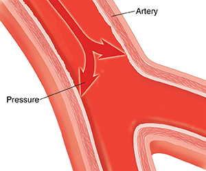 Cross section of artery with arrows showing pressure on artery walls from inside.