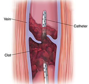 Cross section of muscle and varicose vein with blood clot. Catheter is inserted in vein through blood clot.