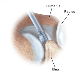 Side view of elbow joint showing instrument removing loose body.