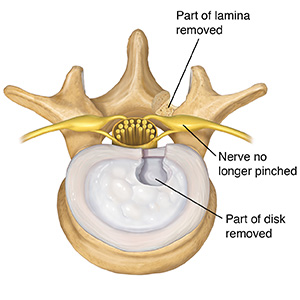 Top view of lumbar vertebra and disk showing rear part of disk removed.