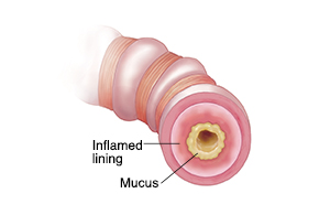 Cross section of bronchiole showing airway mostly blocked by mucus, inflammation, and muscle constriction.