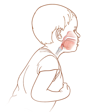 Side view of child leaning over with mouth open. Throat anatomy shows epiglottitis.