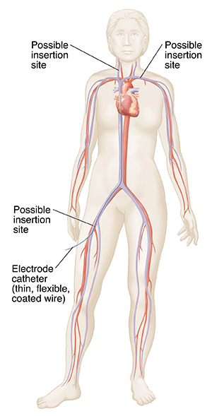 Front view of female outline showing heart, major arteries and veins. Catheter inserted in femoral vein going to right heart. 