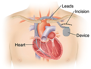Outline of man's chest showing showing biventricular implantable cardioverter defibrillator in chest with three leads going into heart chambers.