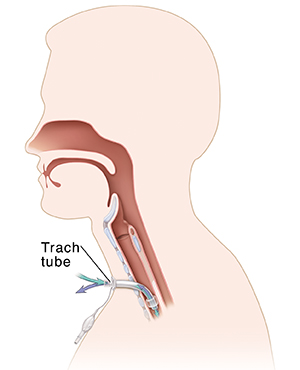 Cross section of head and airway showing cuffed tracheal and pilot tube.