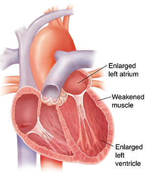Cross section of enlarged heart. Heart walls are thin.