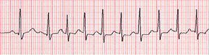 An ECG recording of an irregular heartbeat during an event.