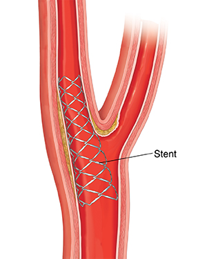 Cross section of carotid artery showing stent in place.