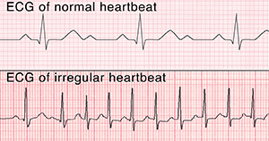 ECG of normal heartbeat. ECG of irregular heartbeat.