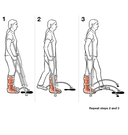 3 steps in using crutches with step through (weight bearing)