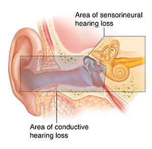 Cross section of ear showing outer, inner, and middle ear structures. Color overlay shows areas causing conductive and sensorineural hearing loss.