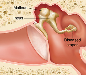Cross section of ear showing outer, inner, and middle ear structures with damaged stapes.
