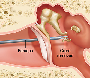 Cross section of ear showing outer, inner, and middle ear structures showing instrument removing damaged stapes.