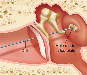 Cross section of ear showing outer, inner, and middle ear structures showing drill making hole in stapes footplate.