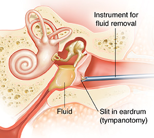 Cross section of child's ear showing fluid in middle ear and inflamed eustachian tube, acute otitis media (AOM).  Instrument is suctioning fluid from inner ear.