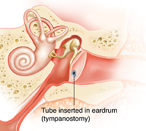 Cross section of child's ear showing fluid in middle ear and inflamed eustachian tube, acute otitis media (AOM). Tube is in eardrum.