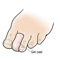 Foot with gel pad on second toe.