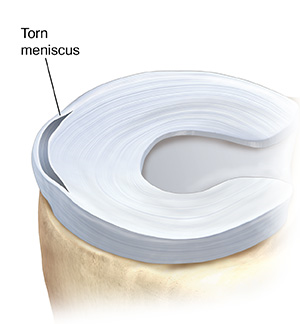 Top view of tibia showing showing peripheral tear in one meniscus.