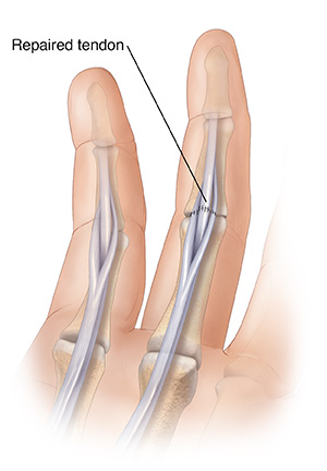Palm view of hand showing sutures repairing cut flexor tendon. 