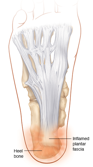Bottom view of the foot showing bones and the plantar fascia with plantar fasciitis.