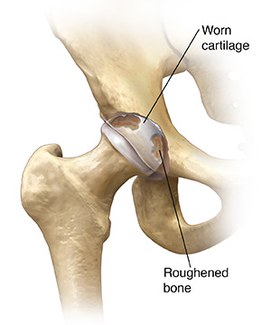 Front view of hip joint showing arthritis.