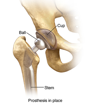 Front view of hip joint with total prosthesis in place.