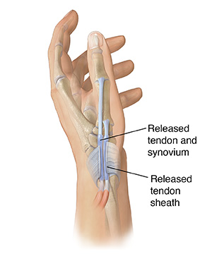 Side view of hand showing tendon sheath cut over tendons in base of thumb to repair DeQuervain's tenosynovitis.
