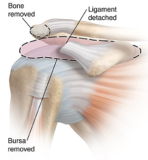 Shoulder Arthroscopy: Conditions Treated