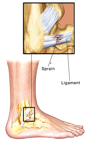 Side view of ankle bones and ligaments with an insets showing a tear in the ligament.