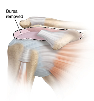 Front view of shoulder joint showing inflamed bursa being removed.
