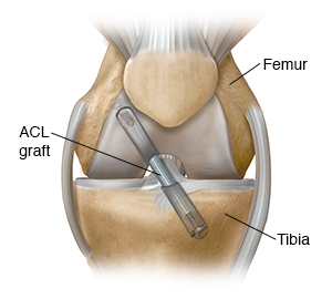 Front view of knee showing graft repair of anterior cruciate ligament.
