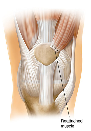 Front view of knee joint showing quad muscle transfer.