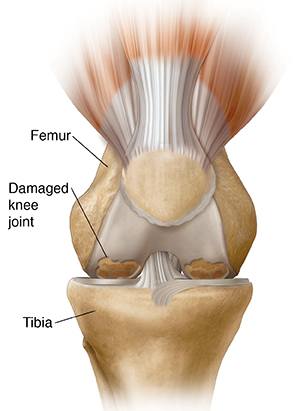 Front view of knee showing osteoarthritis.