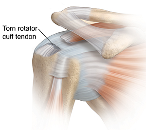 Front view of shoulder joint showing tear in rotator cuff tendon.