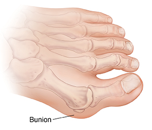 Top view of foot with bones ghosted in, showing bunion.
