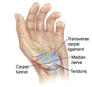 Understanding Carpal Tunnel Syndrome