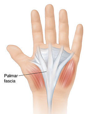 Understanding Dupuytren Contracture