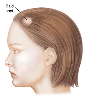 Side view of woman's head showing bald patch.