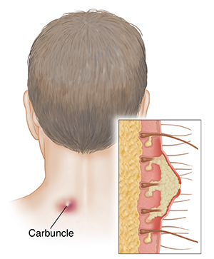 Back of man's head showing carbuncle on neck. Inset of cross section of carbuncle.