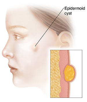Side view of woman's head showing epidermoid cyst. Inset shows cross section of epidermoid cyst.