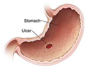 Cross section of stomach showing an ulcer.