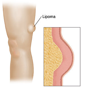 Side view of leg with lipoma under skin of thigh. Inset shows cross section of lipoma.