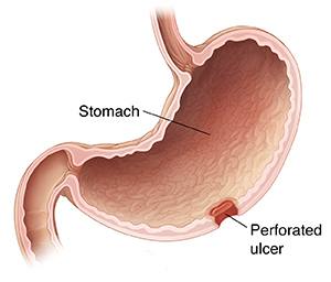 Cross section of stomach showing perforated ulcer.