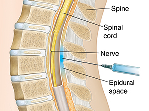 Cross section of lower spine with needle inserted just outside sac surrounding spinal cord.